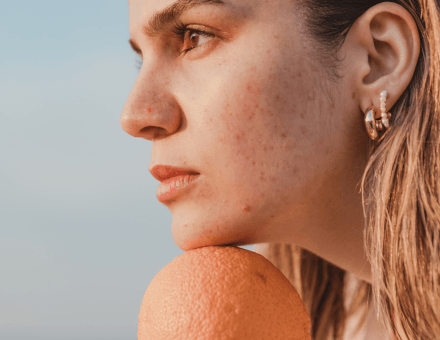 Comment éviter l'effet rebond de l'acné après l'été ? - Forté Pharma