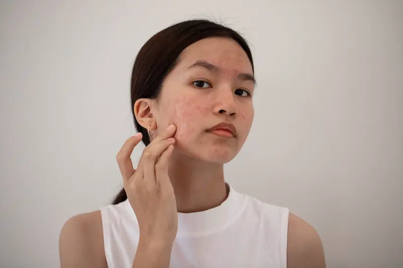 Femme qui a des boutons